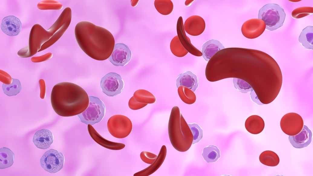 दुनिया में 44 लाख लोगों को है सिकल सेल एनीमिया की बीमारी, इस बीमारी से हो सकती है आपके बच्चों की मौत; जानिए इसके बारे में सब-कुछ
