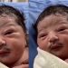 Viral Video:मूंछों के साथ पैदा हुआ बच्चा? दुनिया का ये पहला मामला, सोशल मीडिया पर वीडियो हुआ वायरल